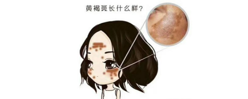 黄褐斑能根治吗?